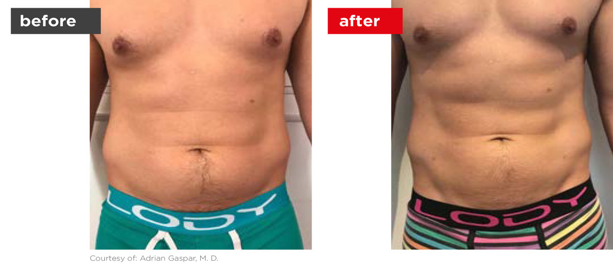 TightSculpting-Before_After-2 TightSculpting-Before_After-2