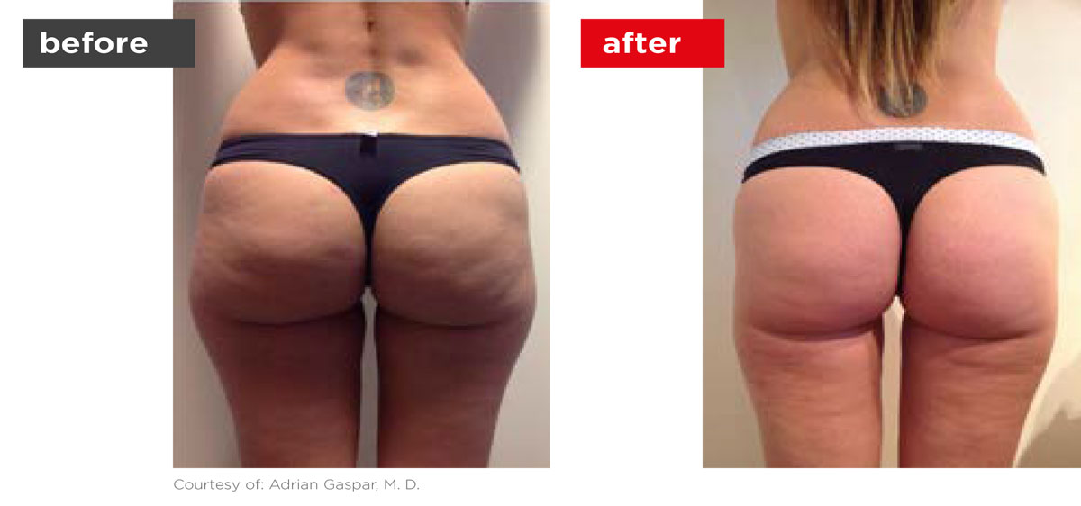TightSculpting-Before_After-3 TightSculpting-Before_After-3