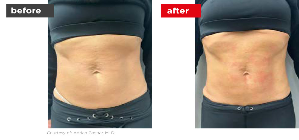TightSculpting-Before_After-4 TightSculpting-Before_After-4