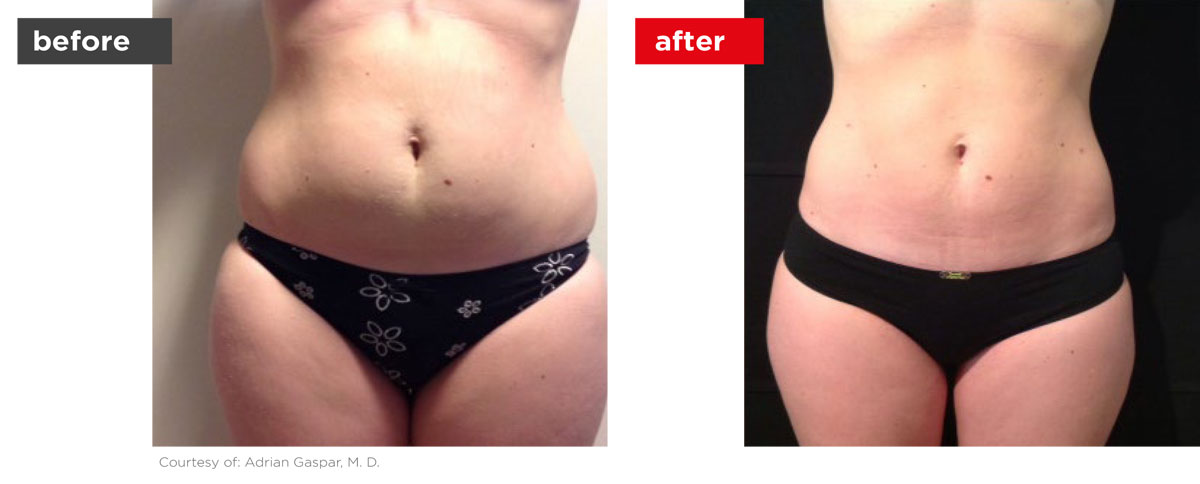 TightSculpting-Before_After-5 TightSculpting-Before_After-5