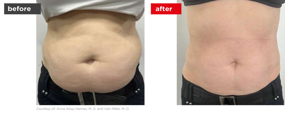 TightSculpting-Before_After-6 TightSculpting-Before_After-6