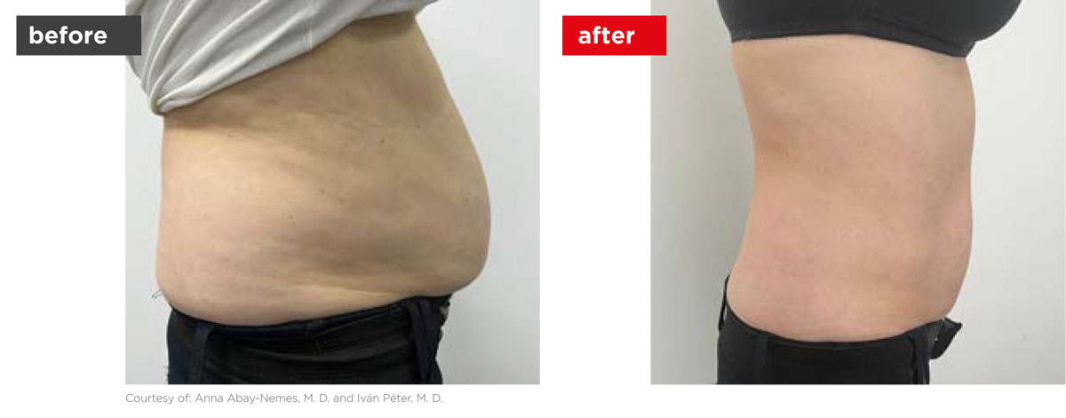 TightSculpting-Before_After-7 TightSculpting-Before_After-7