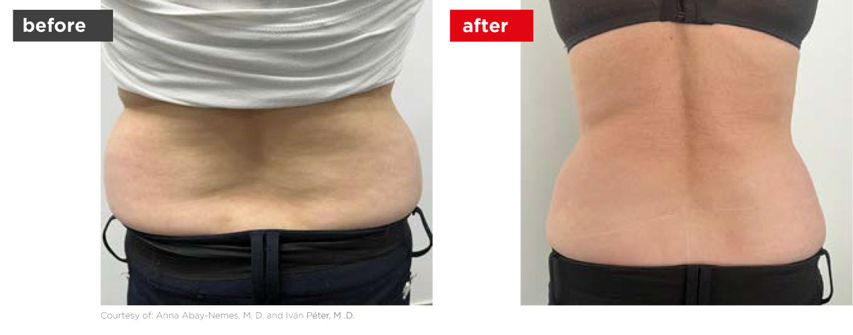 TightSculpting-Before_After-8 TightSculpting-Before_After-8