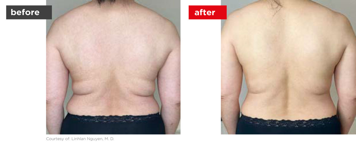TightSculpting-Before_After-9 TightSculpting-Before_After-9