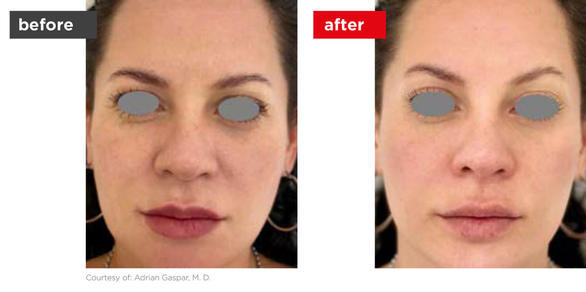 VectorLift-Before_After-1 VectorLift-Before_After-1