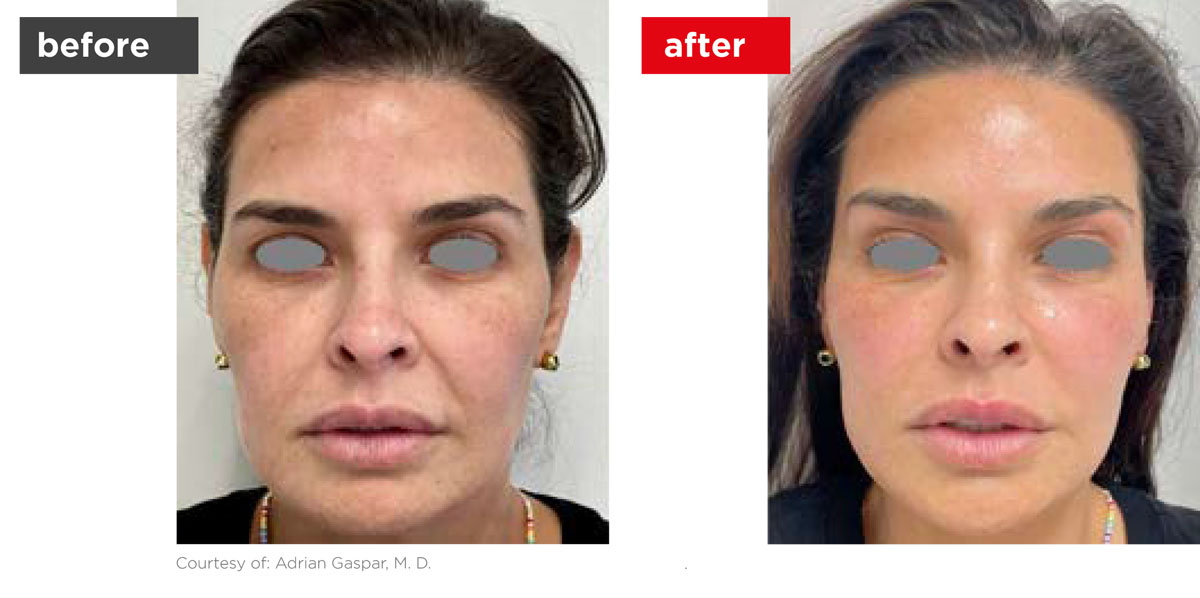 VectorLift-Before_After-2 VectorLift-Before_After-2