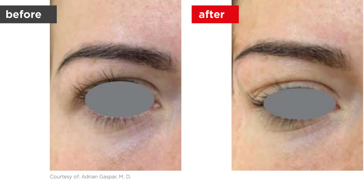 VectorLift-Before_After-3 VectorLift-Before_After-3