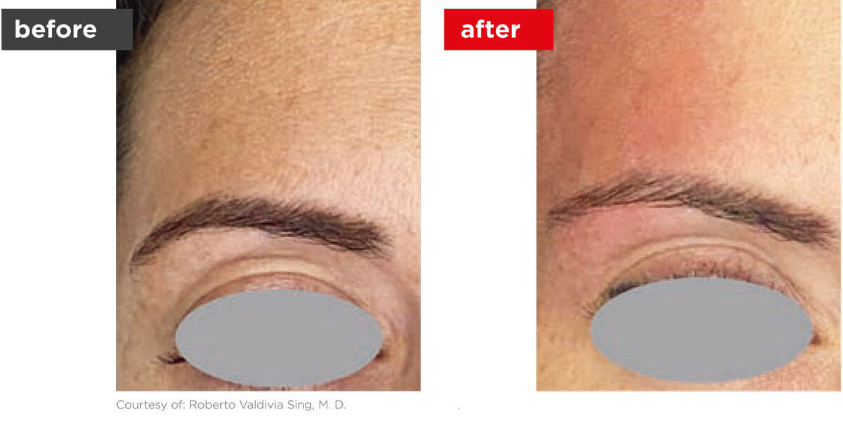 VectorLift-Before_After-4 VectorLift-Before_After-4