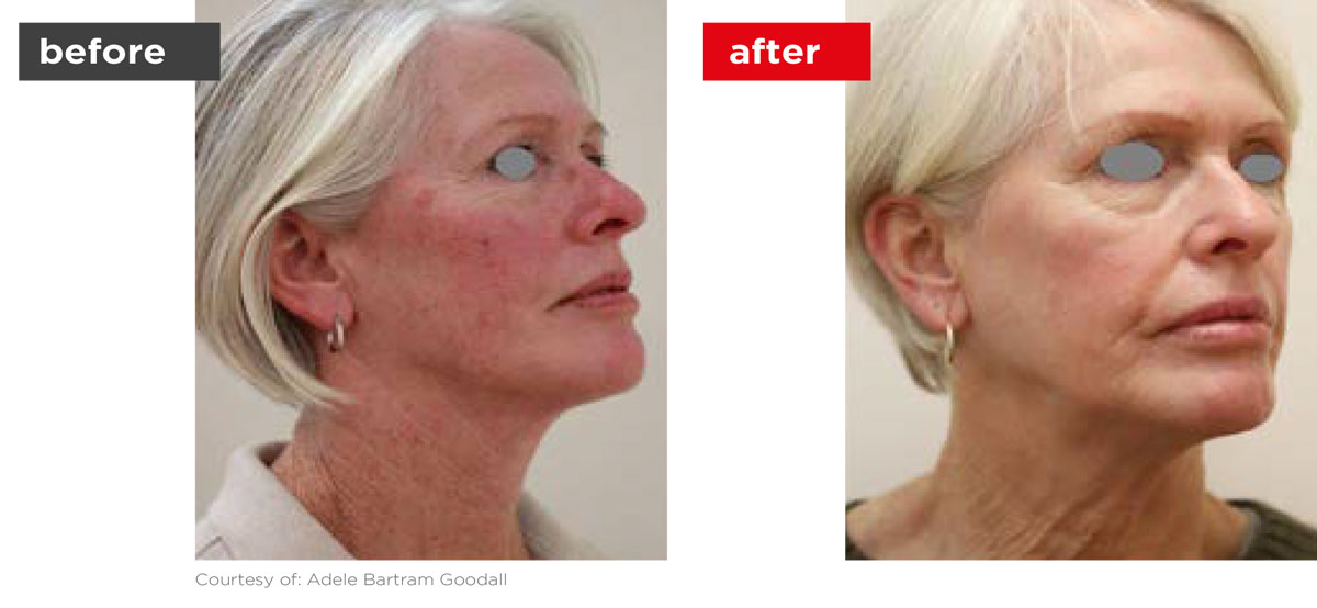 Veins-Before_Afters-1 Veins-Before_Afters-1