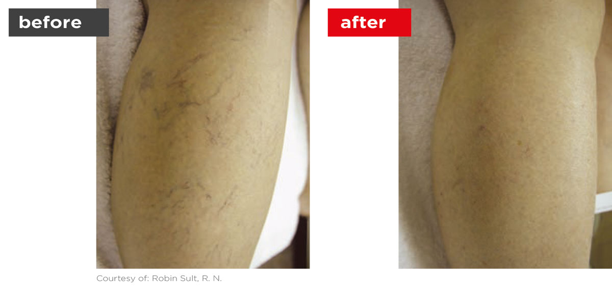 Veins-Before_Afters-10 Veins-Before_Afters-10