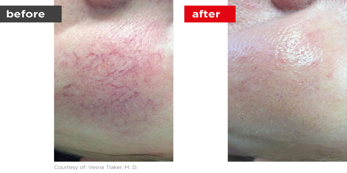 Veins-Before_Afters-11 Veins-Before_Afters-11