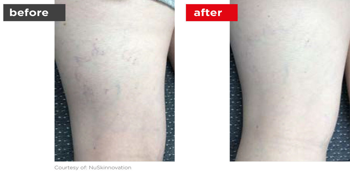 Veins-Before_Afters-12 Veins-Before_Afters-12