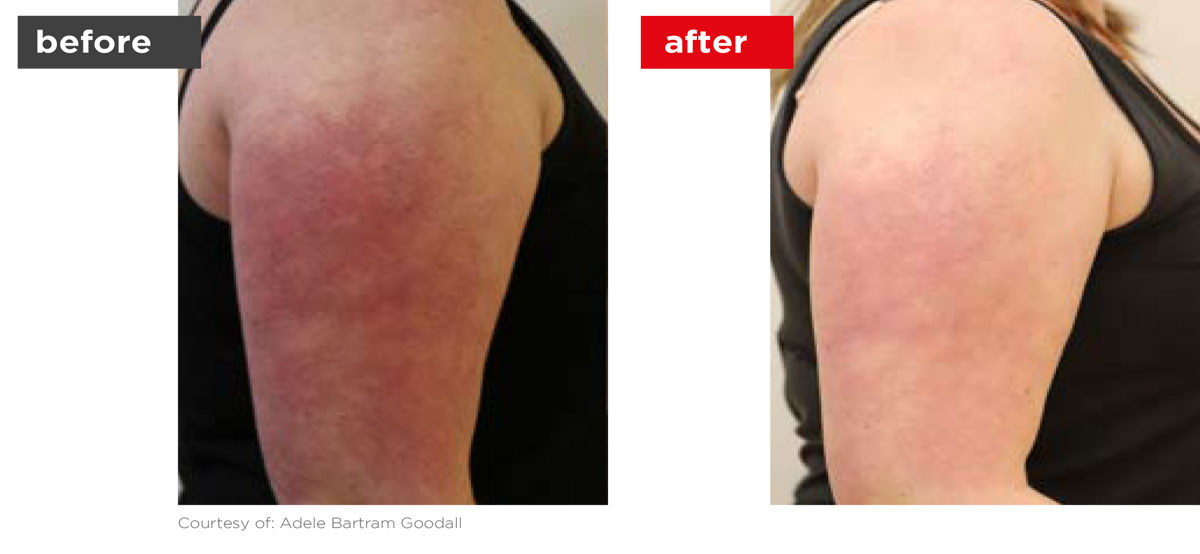 Veins-Before_Afters-2 Veins-Before_Afters-2