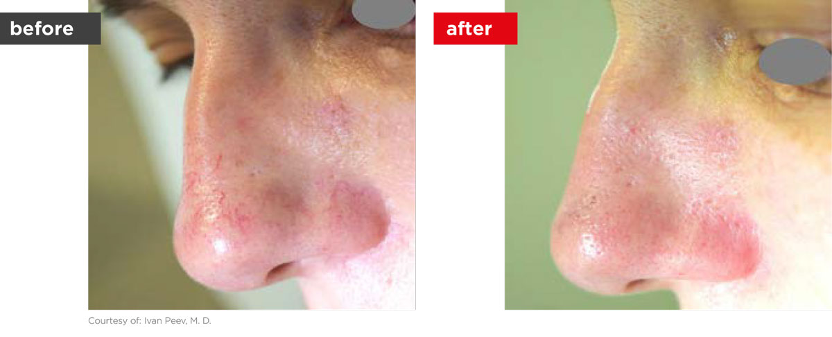 Veins-Before_Afters-3 Veins-Before_Afters-3