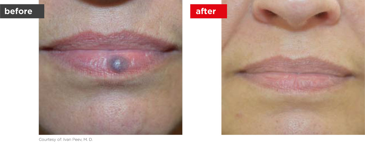 Veins-Before_Afters-4 Veins-Before_Afters-4