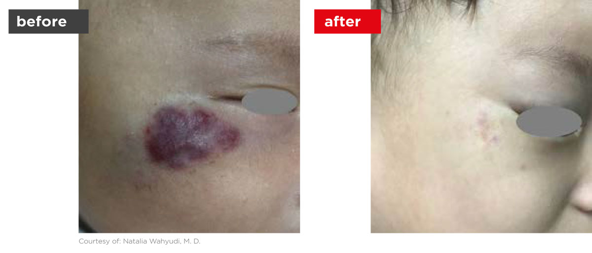 Veins-Before_Afters-5 Veins-Before_Afters-5