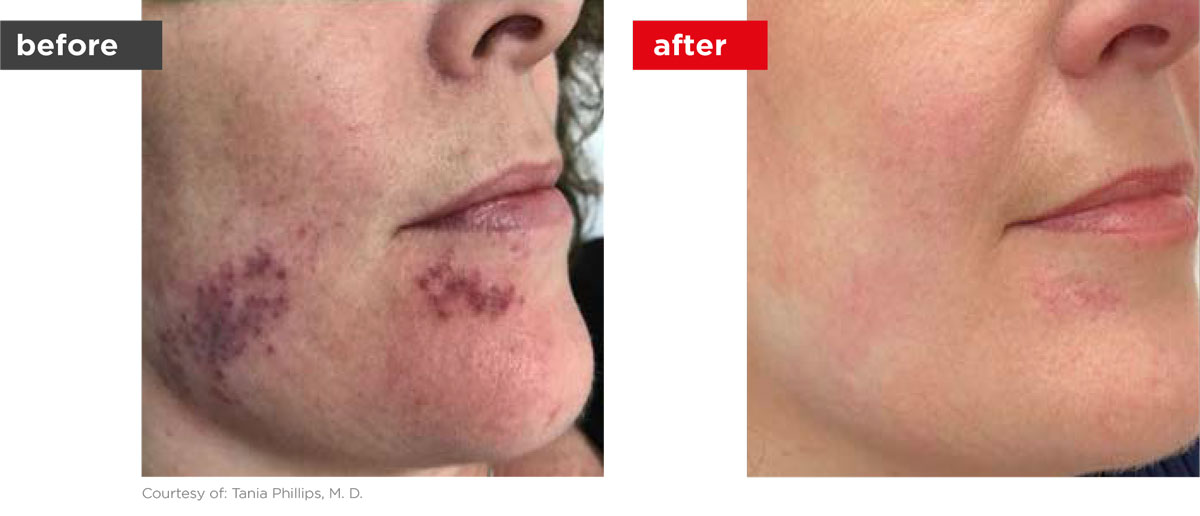 Veins-Before_Afters-7 Veins-Before_Afters-7