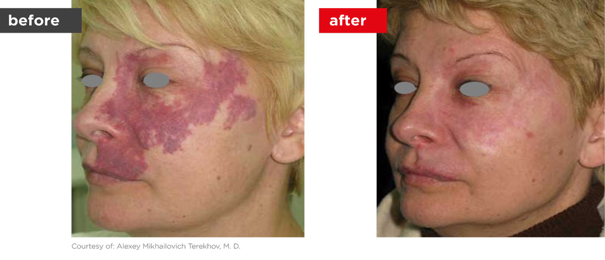 Veins-Before_Afters-8 Veins-Before_Afters-8