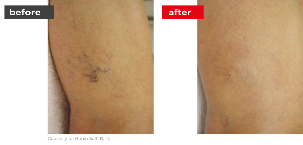 Veins-Before_Afters-9 Veins-Before_Afters-9
