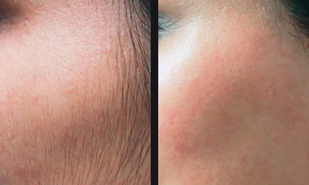 gentle-hair-removal-candela-p1.jpg gentle-hair-removal-candela-p1.jpg