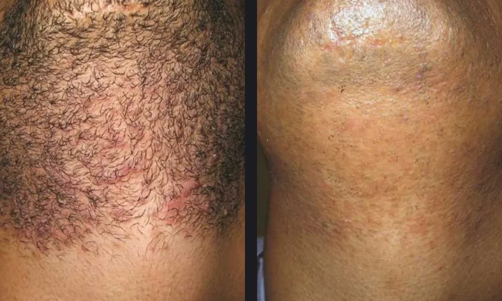 gentle-hair-removal-candela-p3.jpg gentle-hair-removal-candela-p3.jpg