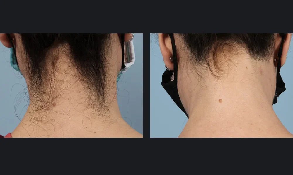 gentlemaxpro-plus-hair-removal-candela-2tx-p1.jpg gentlemaxpro-plus-hair-removal-candela-2tx-p1.jpg